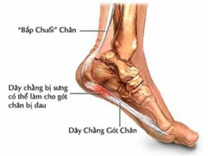 Đứt gân gót chân - Hình ảnh minh họa